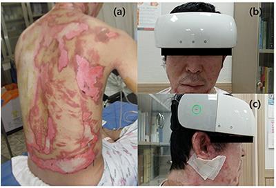 Frontal lobe hemodynamics detected by functional near-infrared spectroscopy during head-up tilt table tests in patients with electrical burns